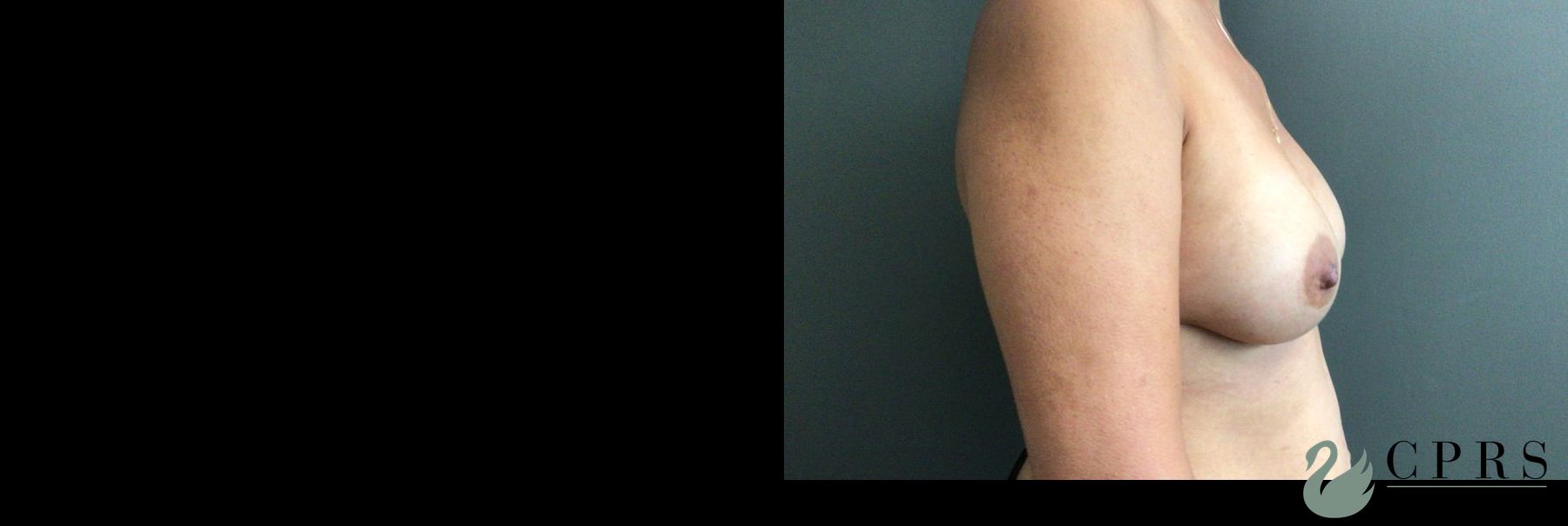 Before and after Breast Augmentation case 43650 - Angle 3