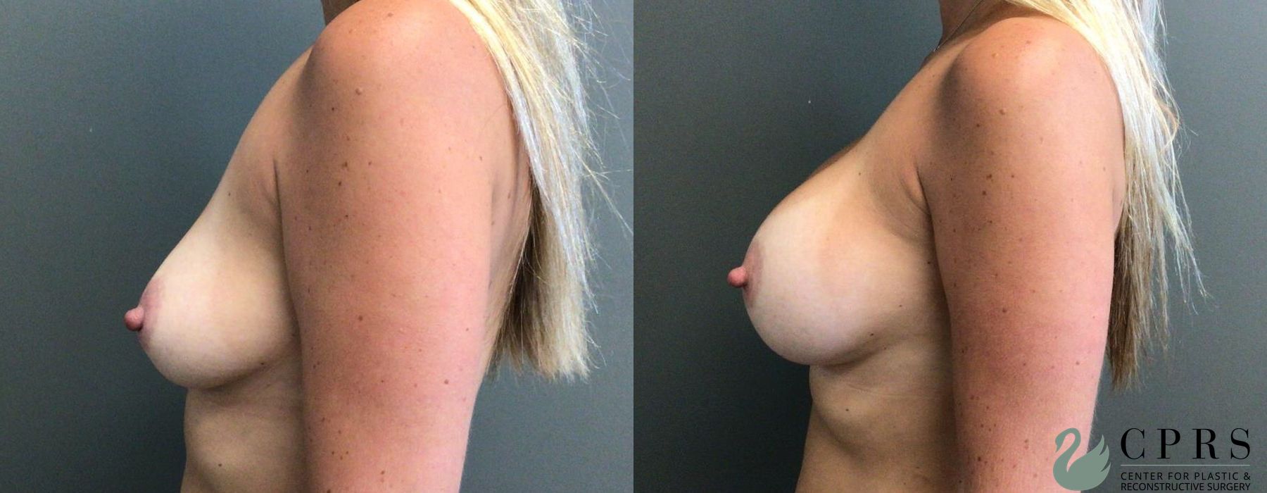 Before and after Breast Augmentation case 19117 - Angle 3