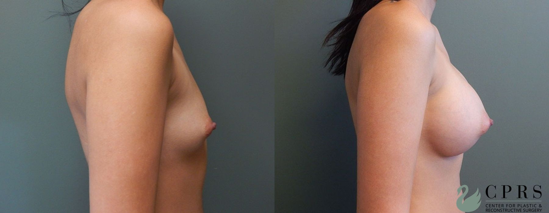 Before and after Breast Augmentation case 18929 - Angle 2