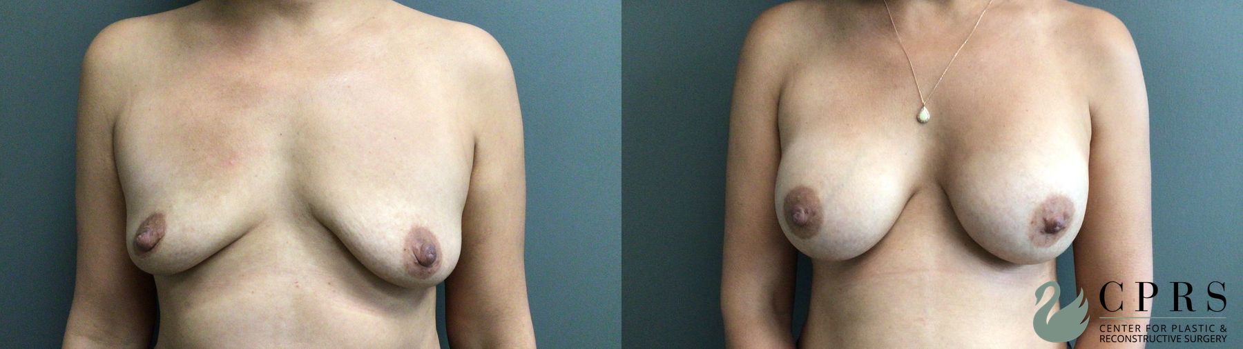 Before and after Breast Augmentation case 43650