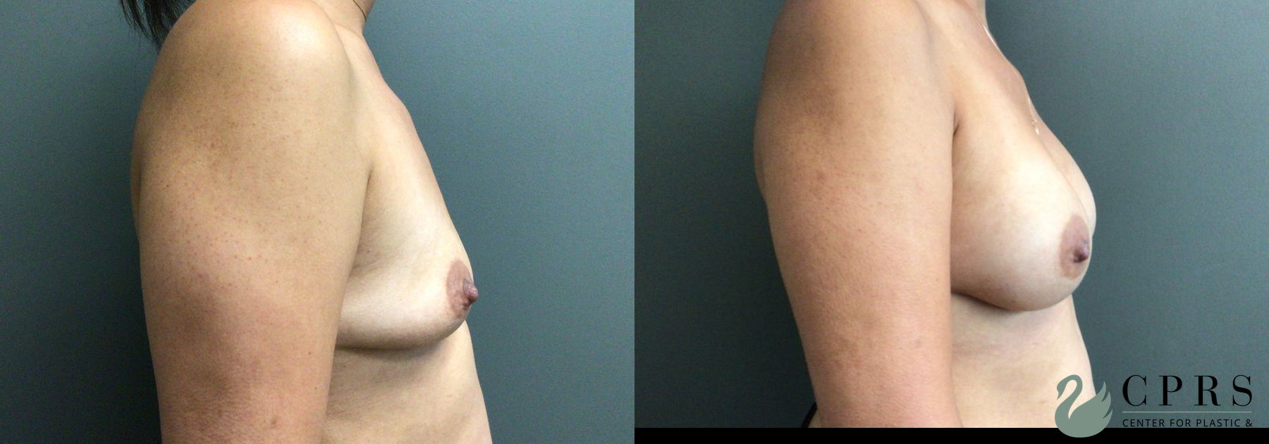 Before and after Breast Augmentation case 46140 - Angle 2