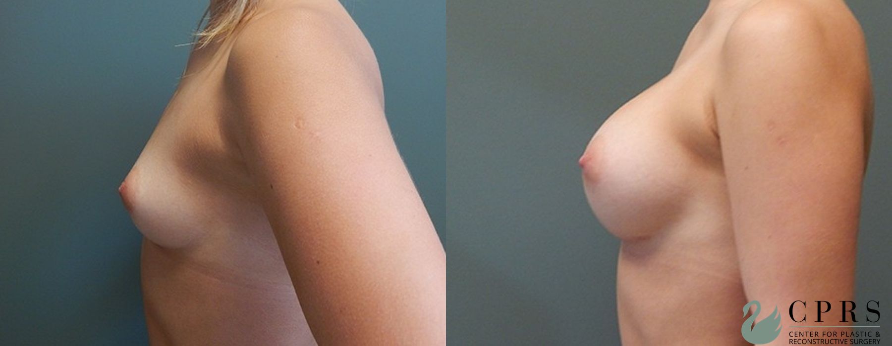 Before and after Breast Augmentation case 18996 - Angle 2