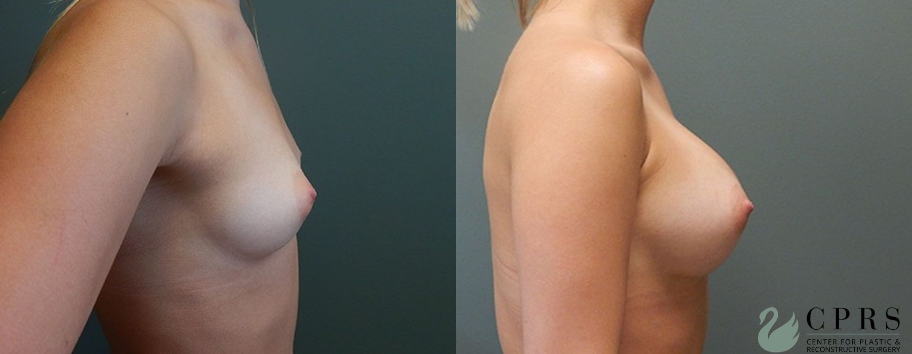 Before and after Breast Augmentation case 18996