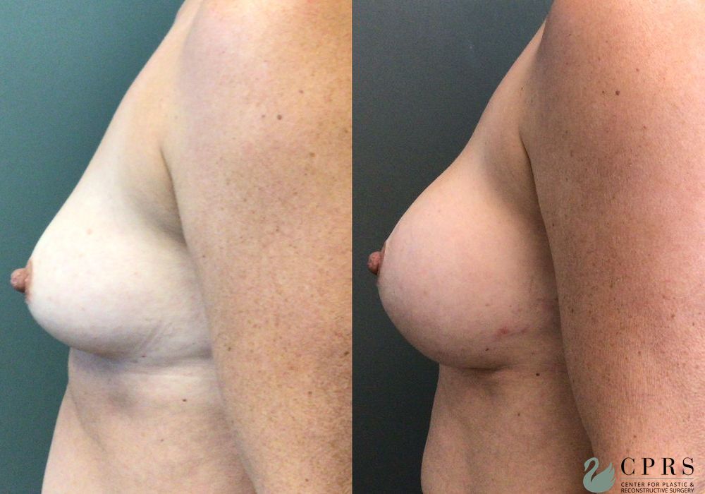 Breast Augmentation - Thumbnail 3