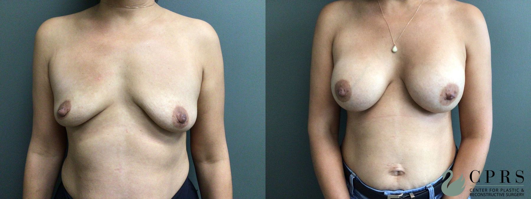 Before and after Breast Augmentation case 46140