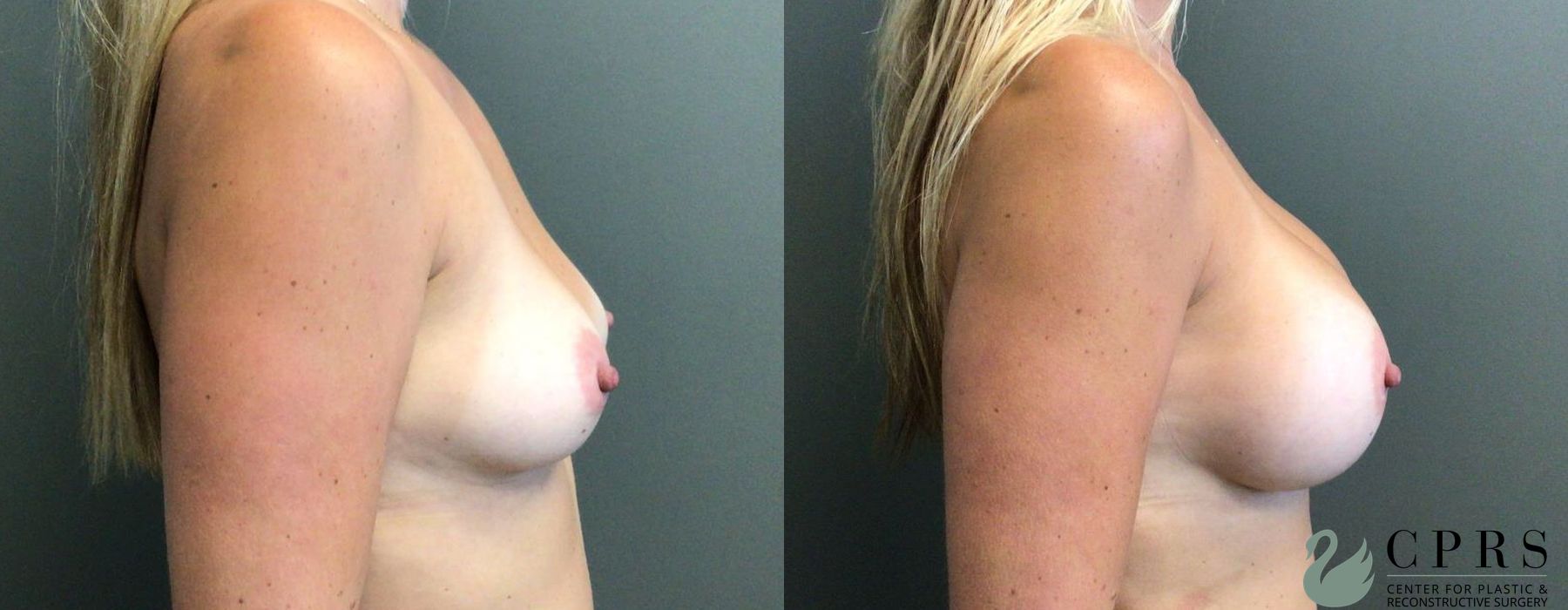 Before and after Breast Augmentation case 19117 - Angle 2