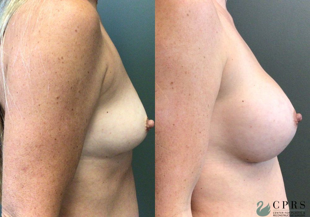 Breast Augmentation - Thumbnail 2