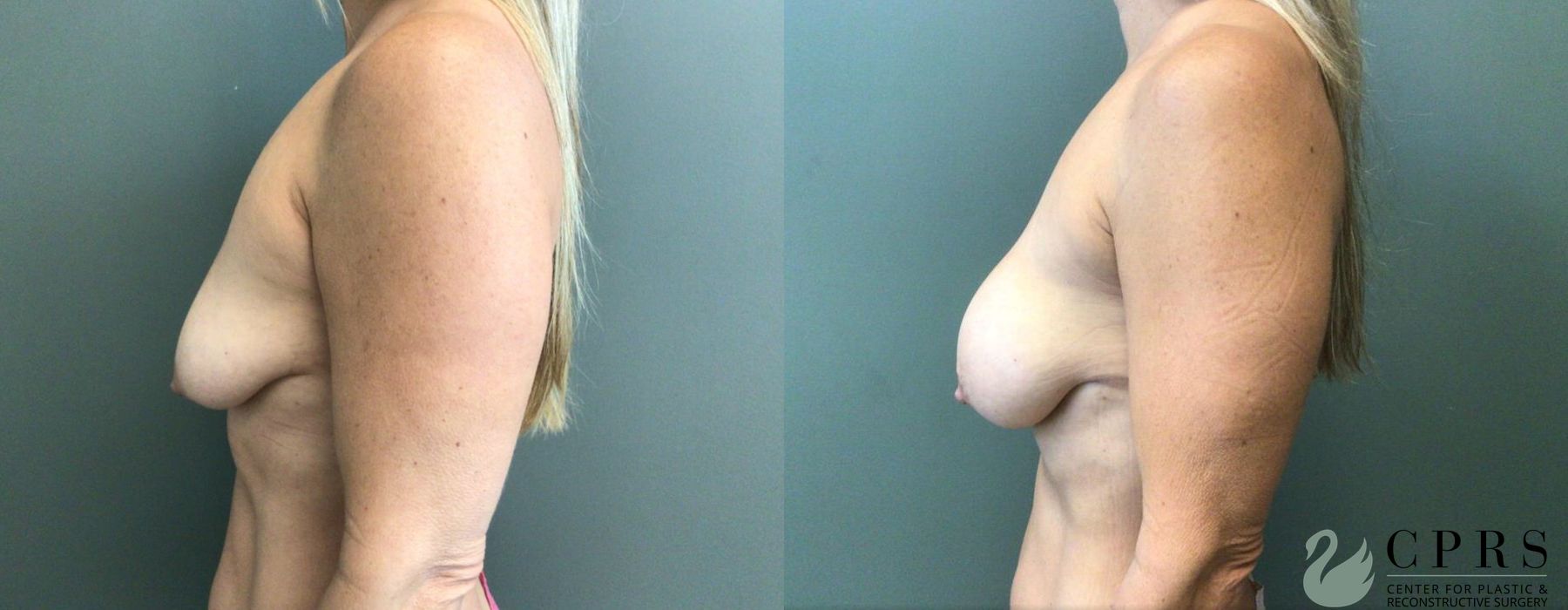 Breast Augmentation - Thumbnail 3
