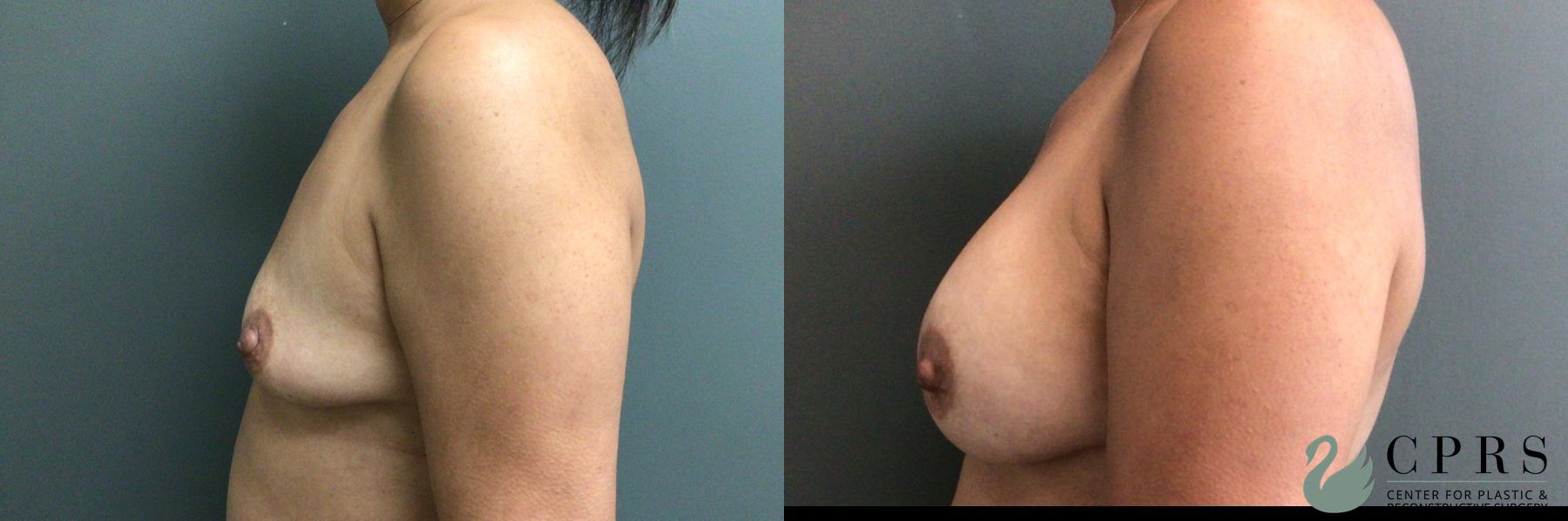 Before and after Breast Augmentation case 43650 - Angle 2