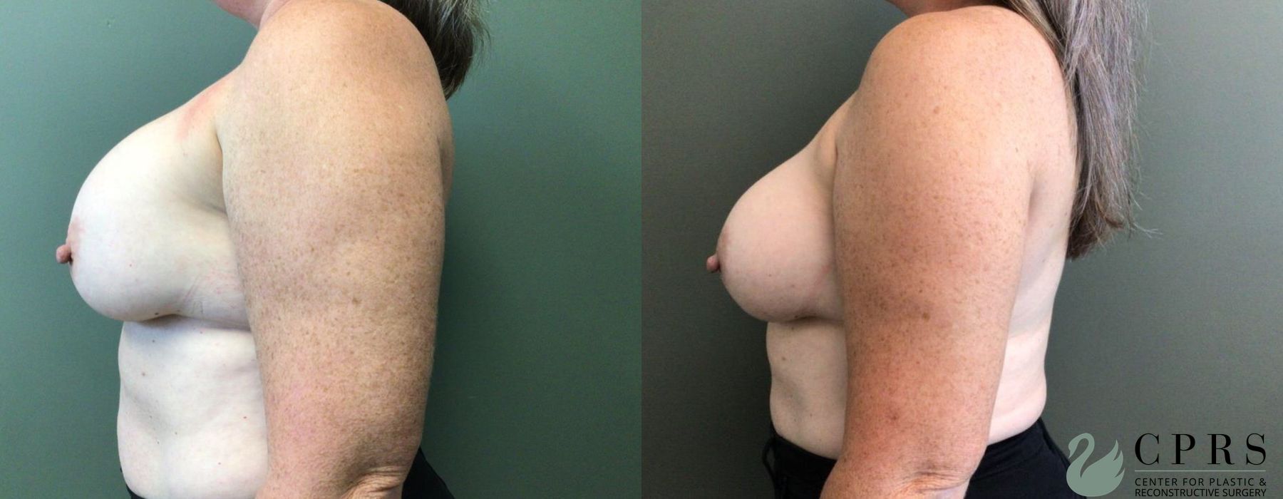 Breast Augmentation - Thumbnail 3