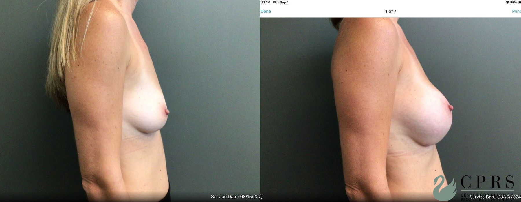 Before and after Breast Augmentation case 19202 - Angle 2