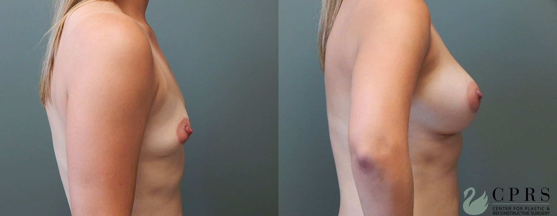 Breast Augmentation - Thumbnail 3