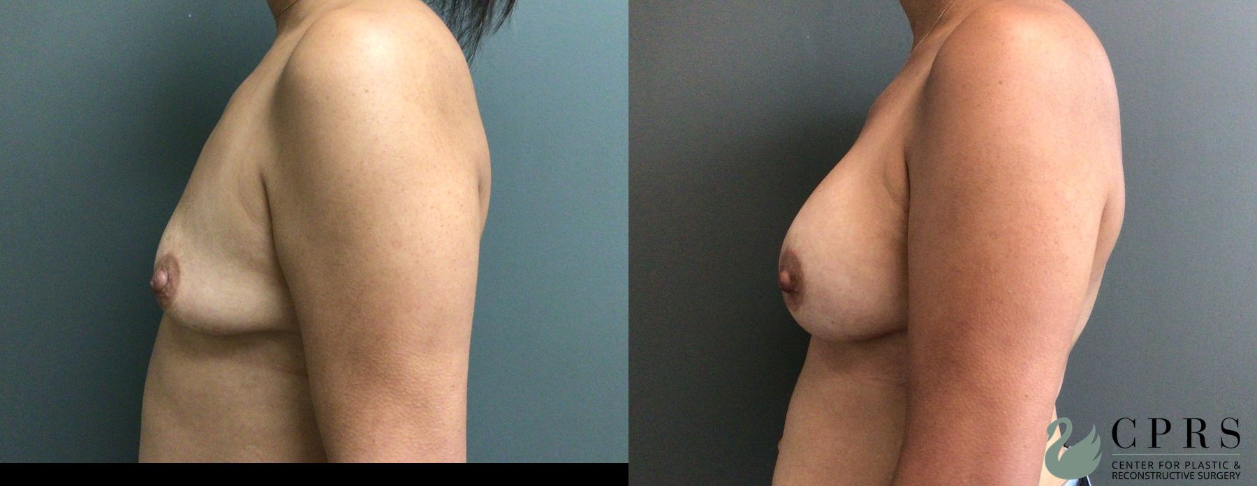 Before and after Breast Augmentation case 46140 - Angle 3