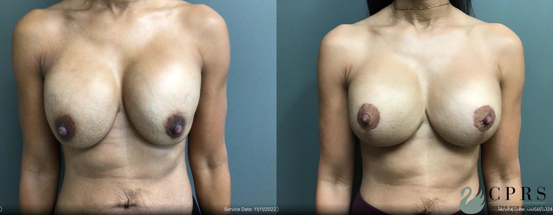Before and after Breast Augmentation with Lift case 19179