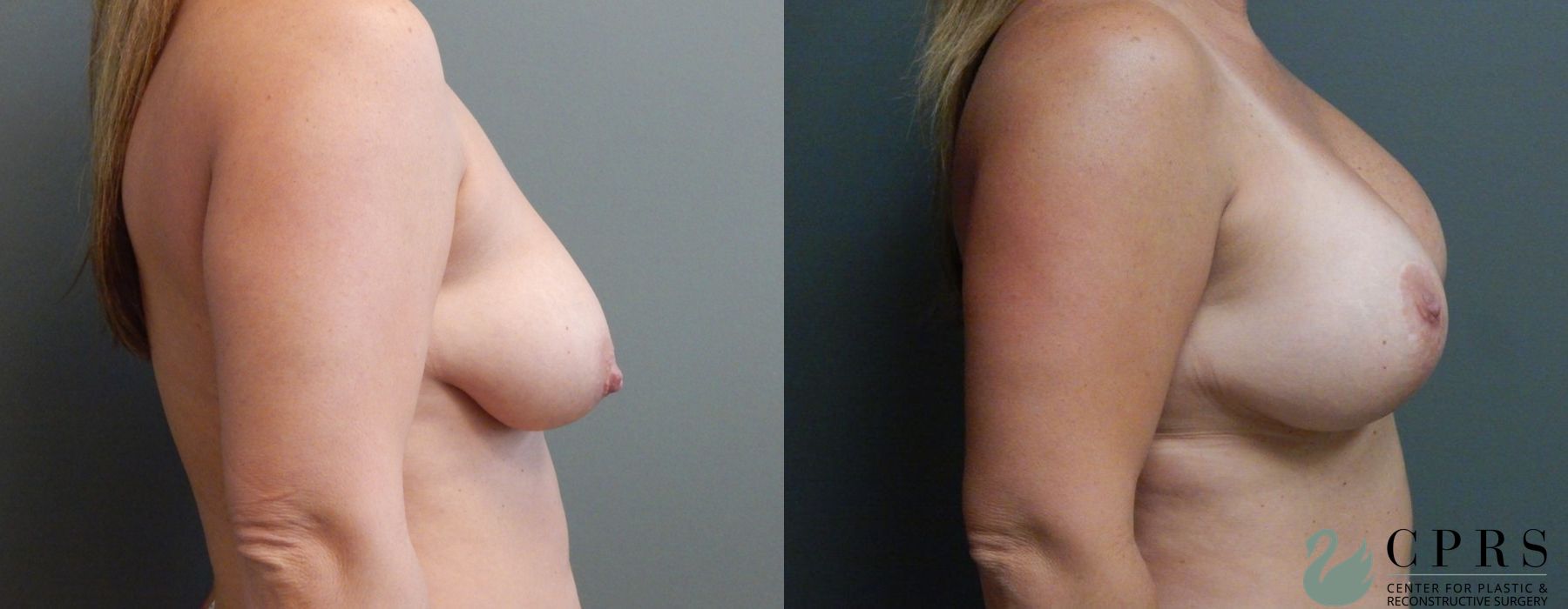 Before and after Breast Augmentation with Lift case 19072 - Angle 3