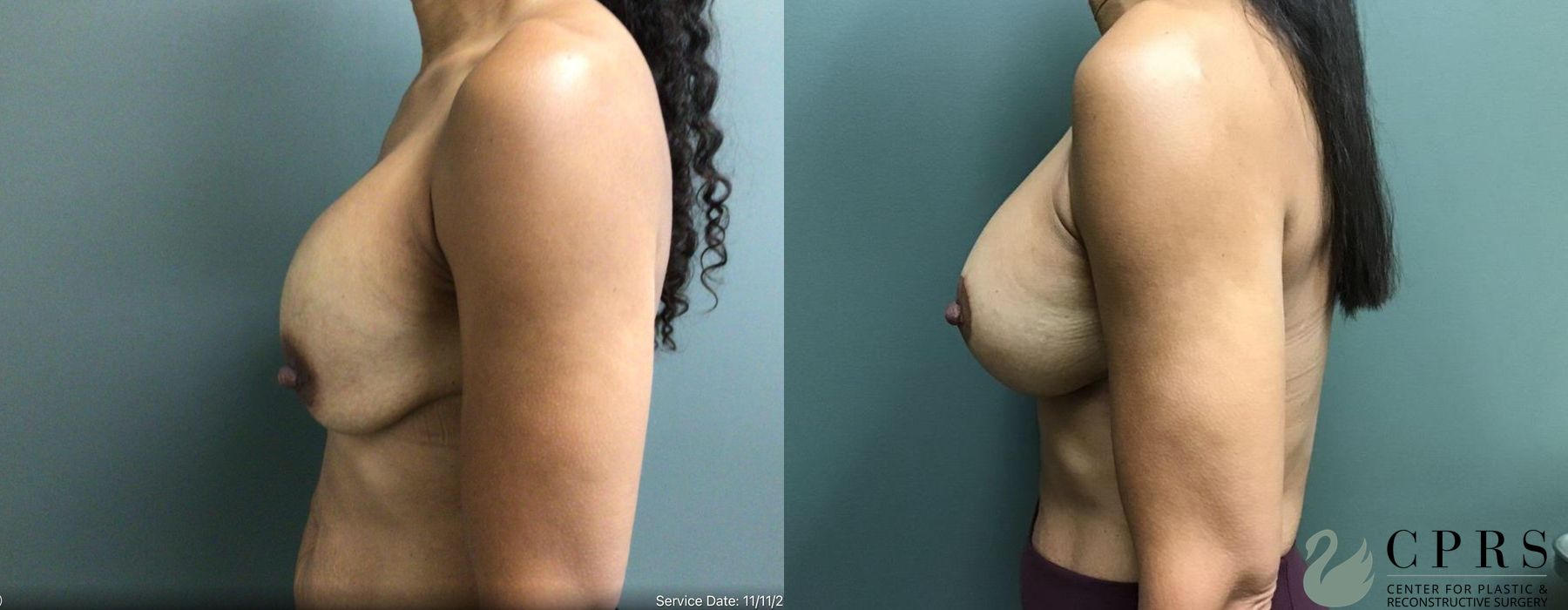 Before and after Breast Augmentation with Lift case 19179 - Angle 2
