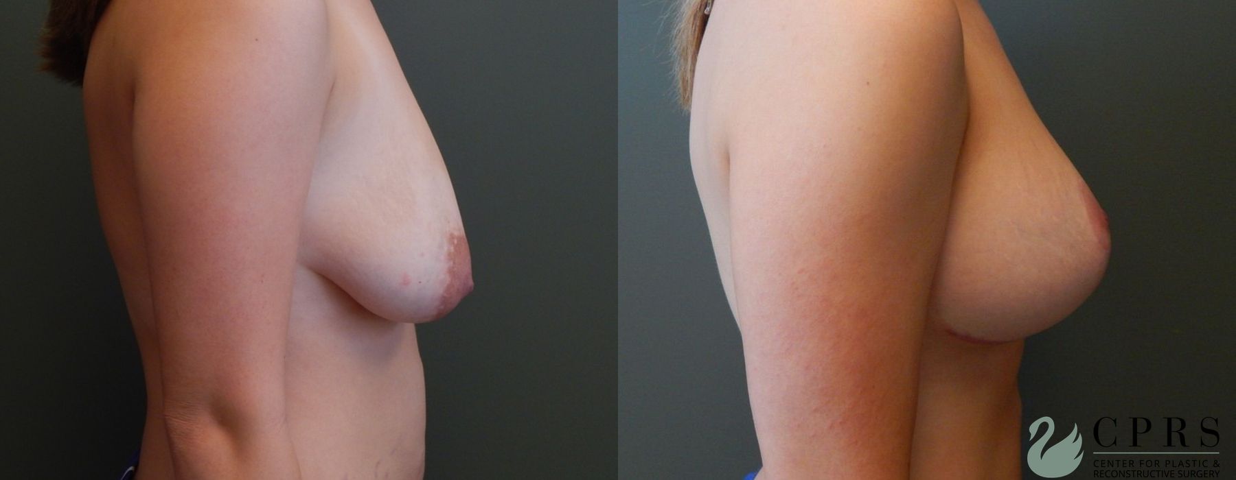 Before and after Breast Augmentation with Lift case 19056 - Angle 3