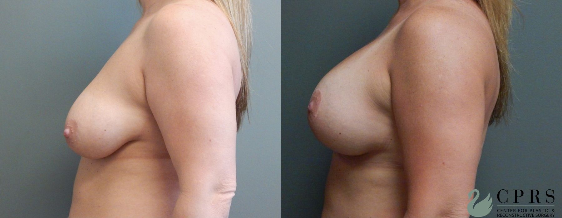 Before and after Breast Augmentation with Lift case 19072 - Angle 2