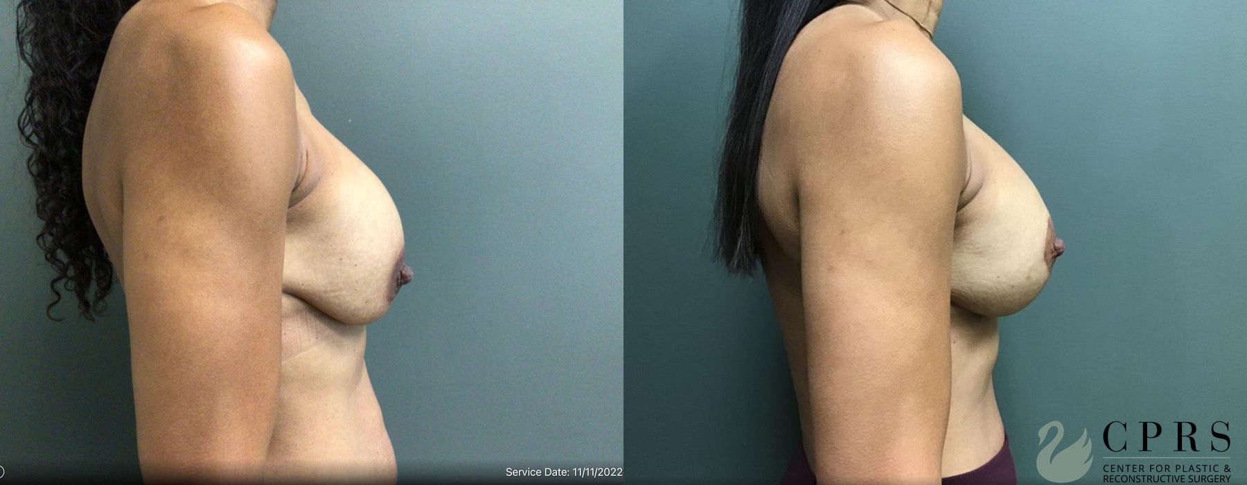 Before and after Breast Augmentation with Lift case 19179 - Angle 3