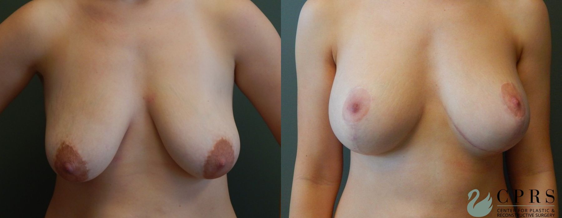 Before and after Breast Augmentation with Lift case 19056