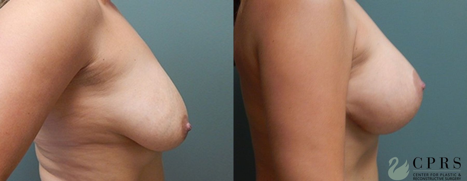 Before and after Breast Augmentation with Lift case 18943 - Angle 3