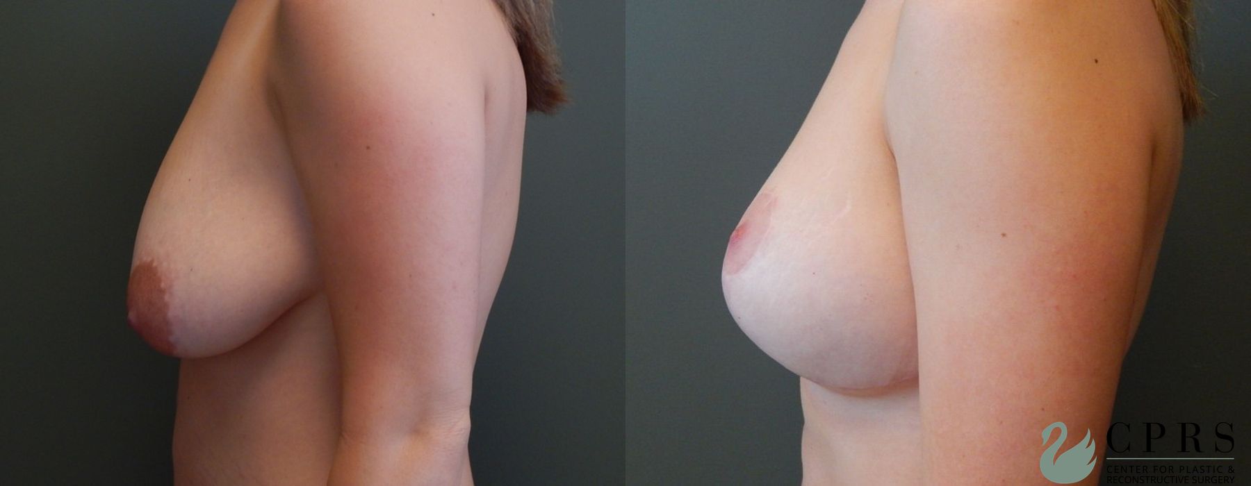 Before and after Breast Augmentation with Lift case 19056 - Angle 2