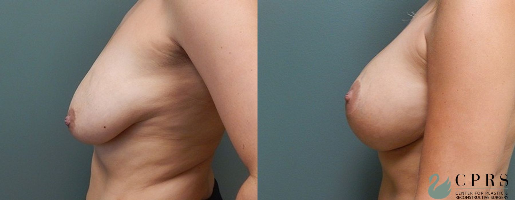 Before and after Breast Augmentation with Lift case 18943 - Angle 2
