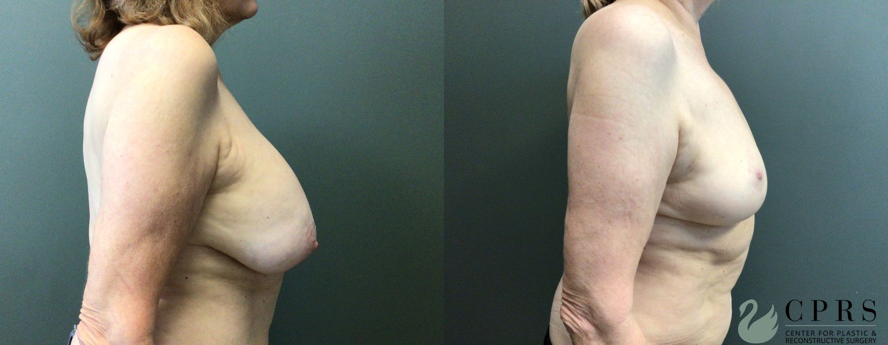 Before and after Breast Implant Removal case 21473 - Angle 3