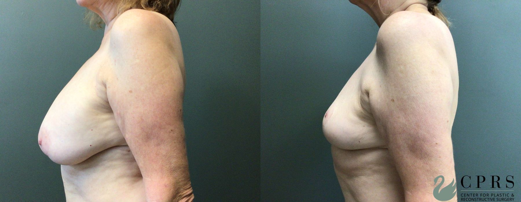 Before and after Breast Implant Removal case 21473 - Angle 2