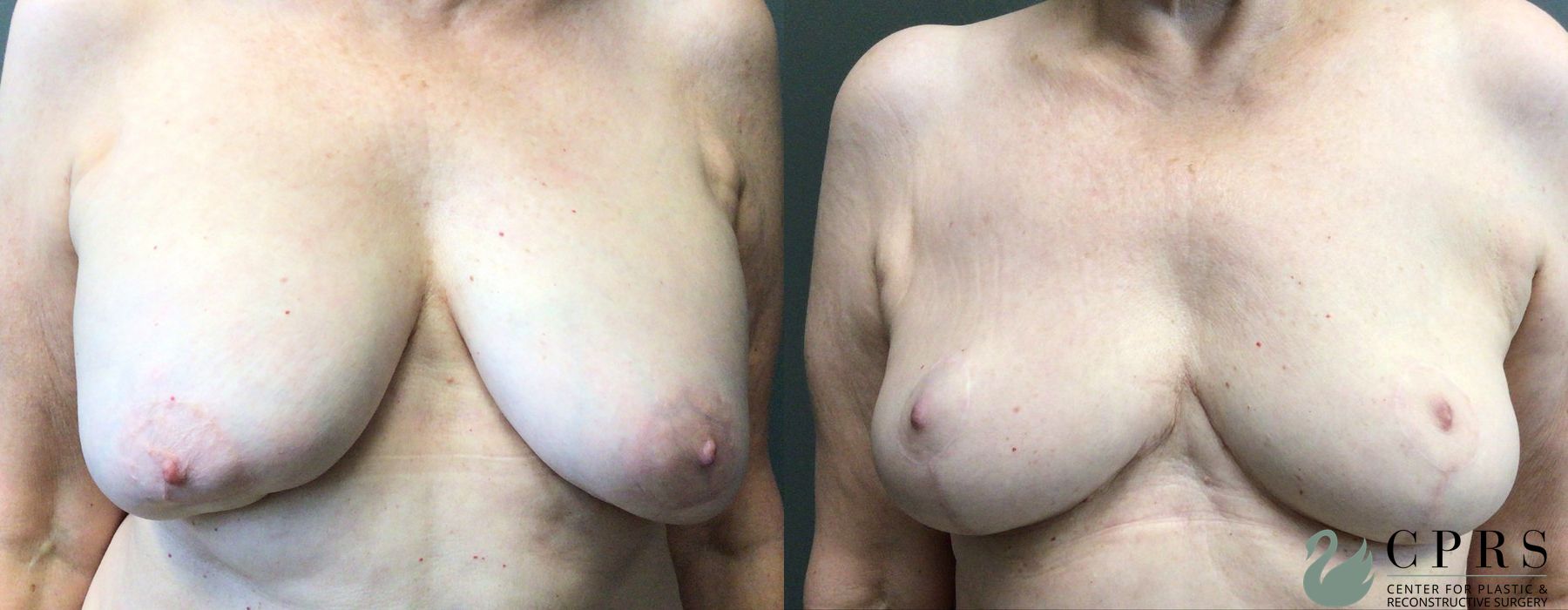 Before and after Breast Implant Removal case 21473