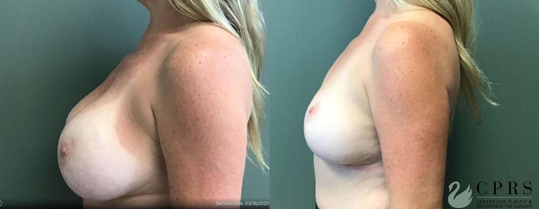 Before and after Breast Implant Removal with Lift case 19127 - Angle 2