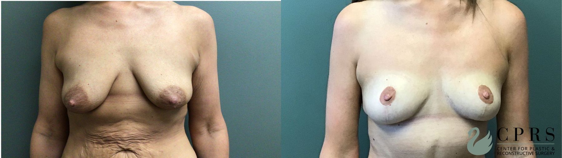 Before and after Breast Lift case 41319