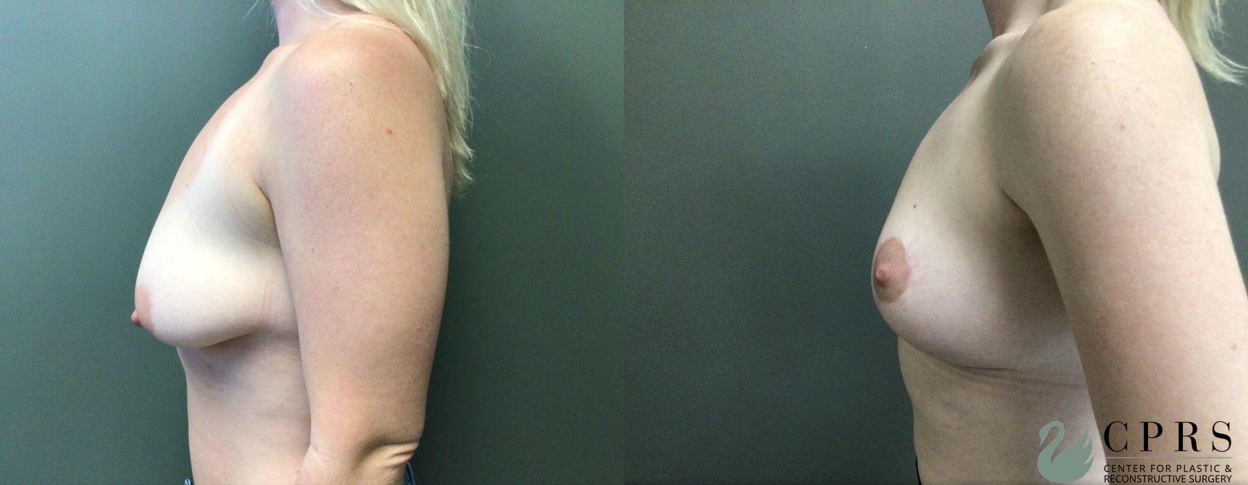 Before and after Breast Lift case 19113 - Angle 3
