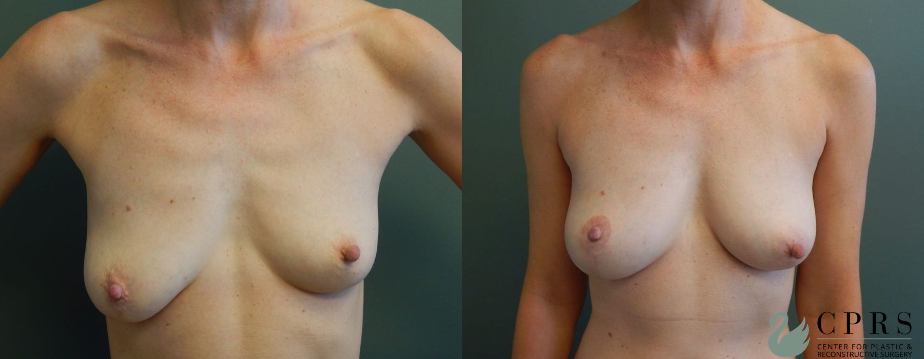 Before and after Breast Lift case 18954
