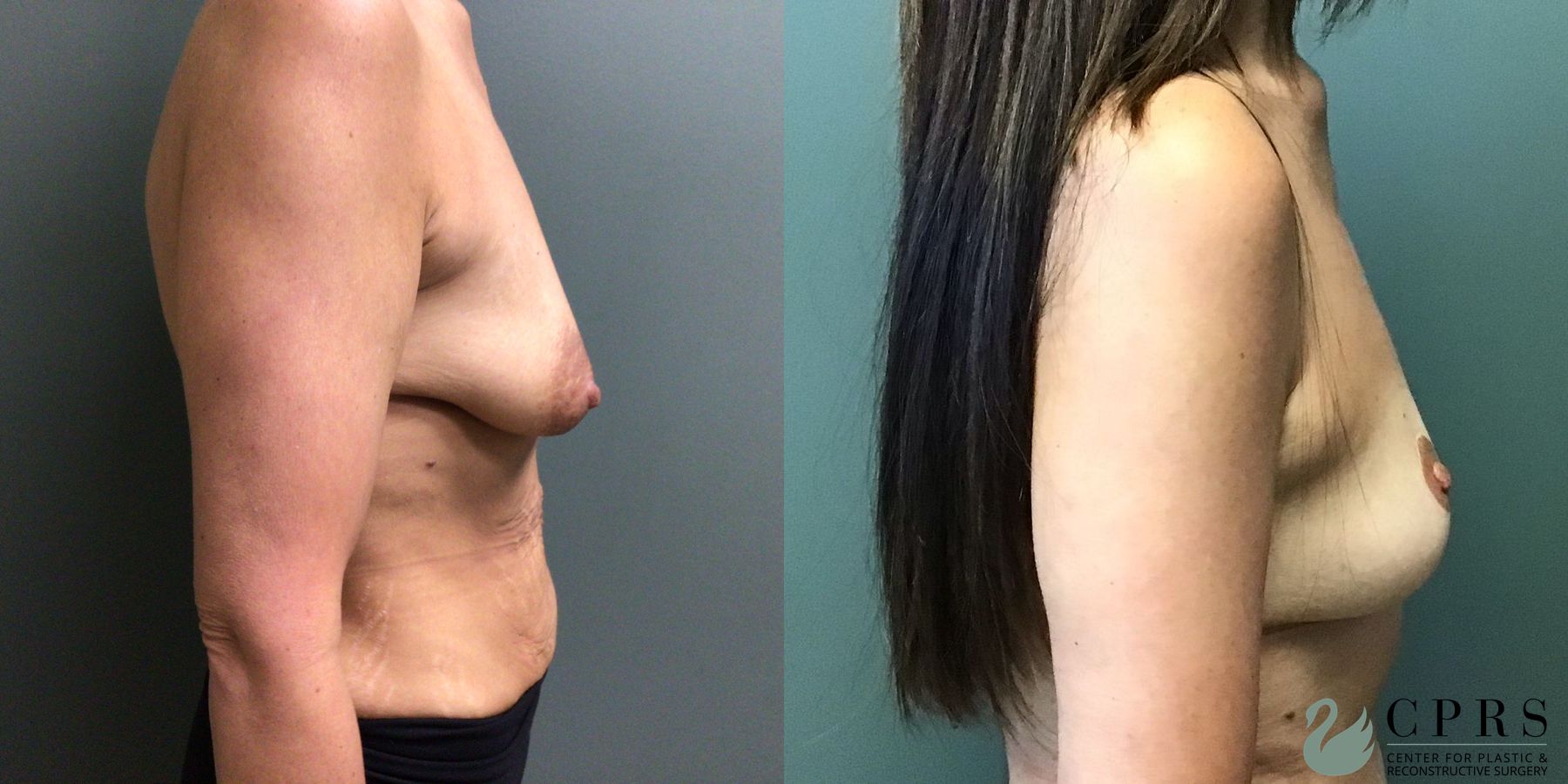 Before and after Breast Lift case 41319 - Angle 2