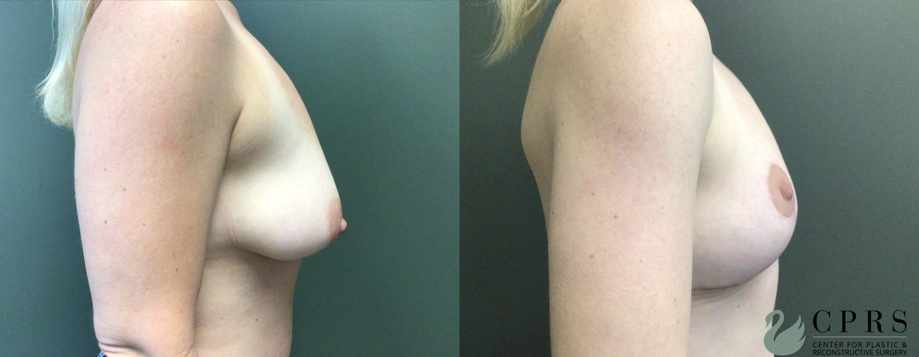 Before and after Breast Lift case 19113 - Angle 2