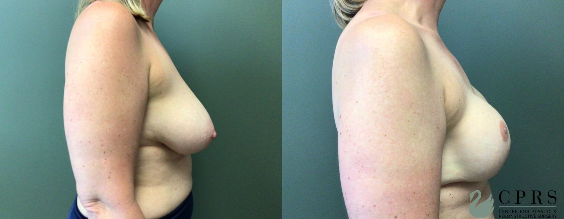 Before and after Breast Reconstruction case 19073 - Angle 3