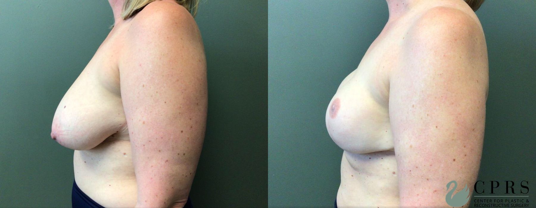 Before and after Breast Reconstruction case 19073 - Angle 2