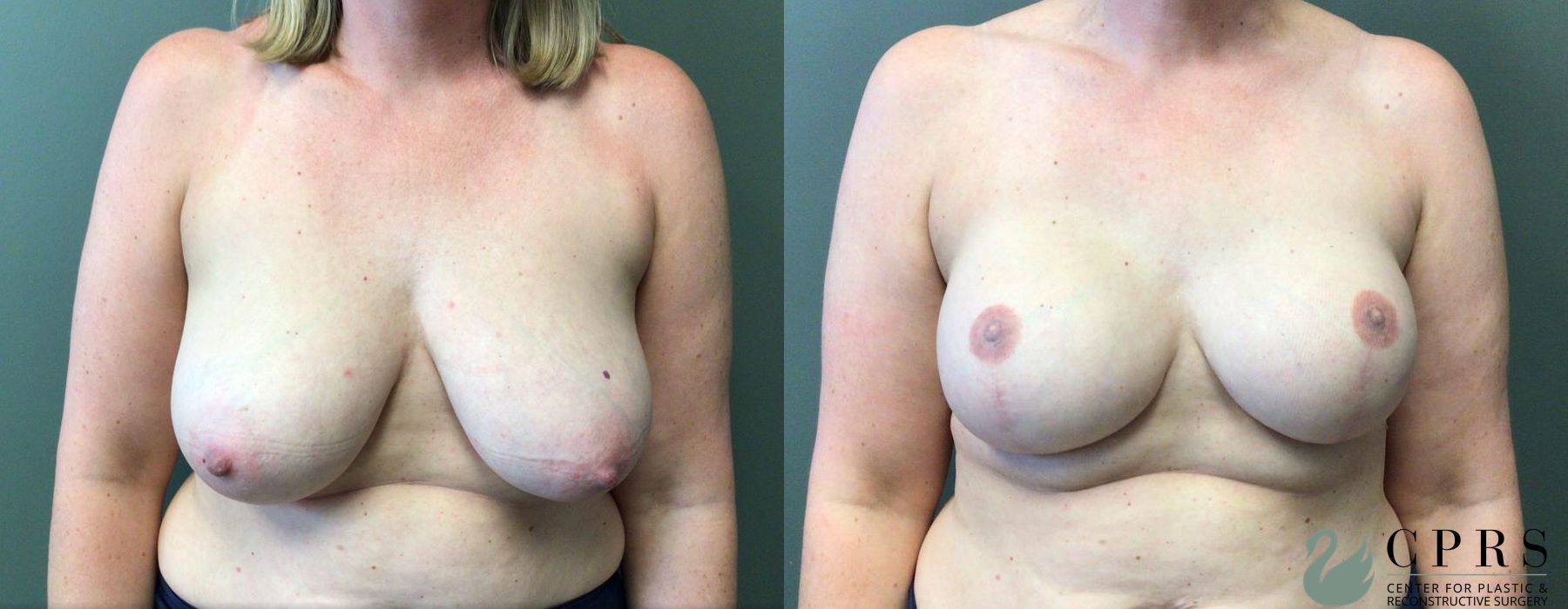 Before and after Breast Reconstruction case 19073