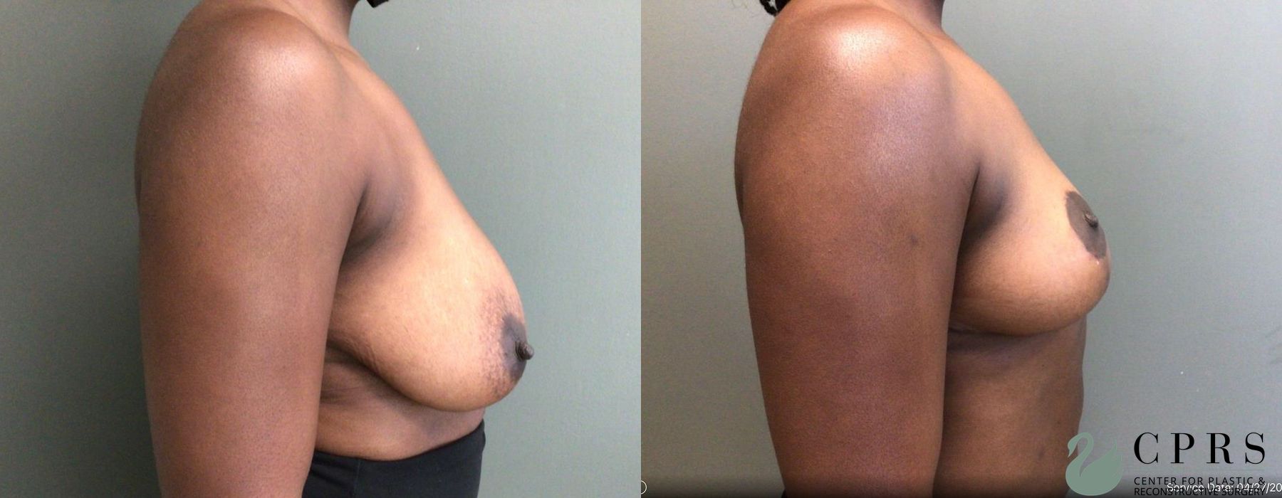 Before and after Breast Reduction case 19138 - Angle 3