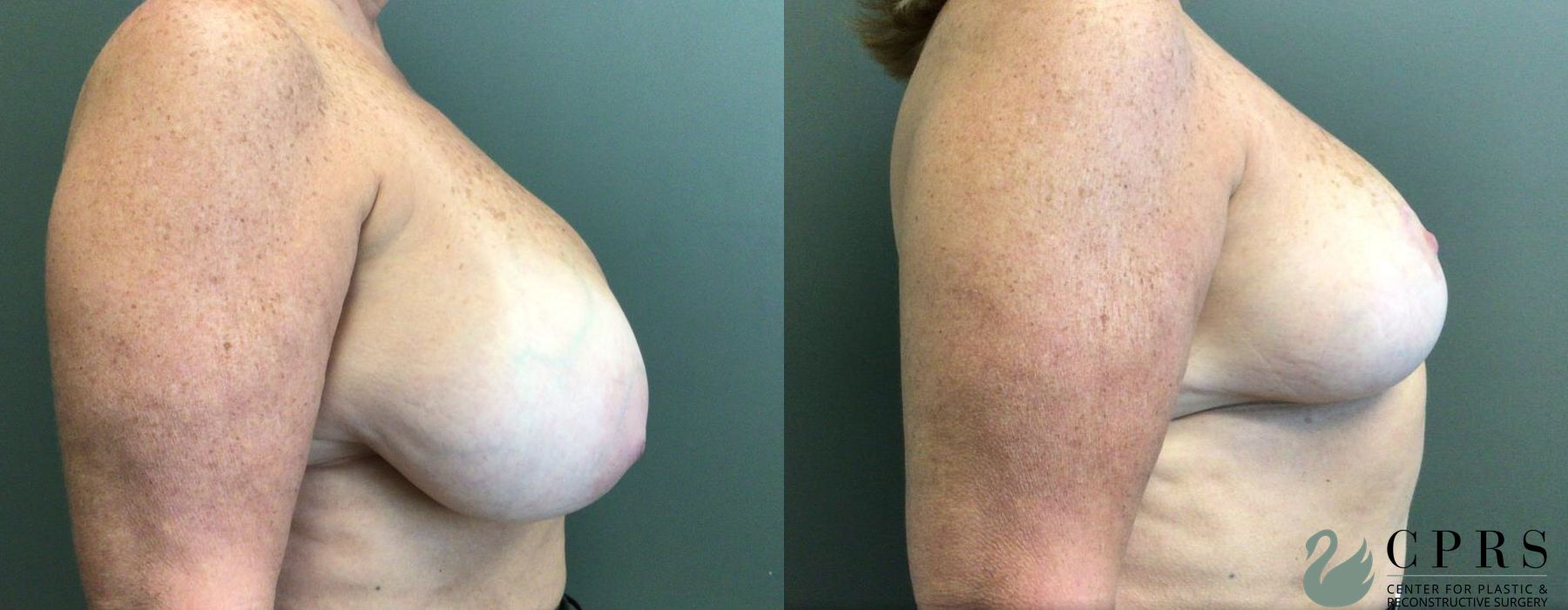 Before and after Breast Reduction case 19010 - Angle 3