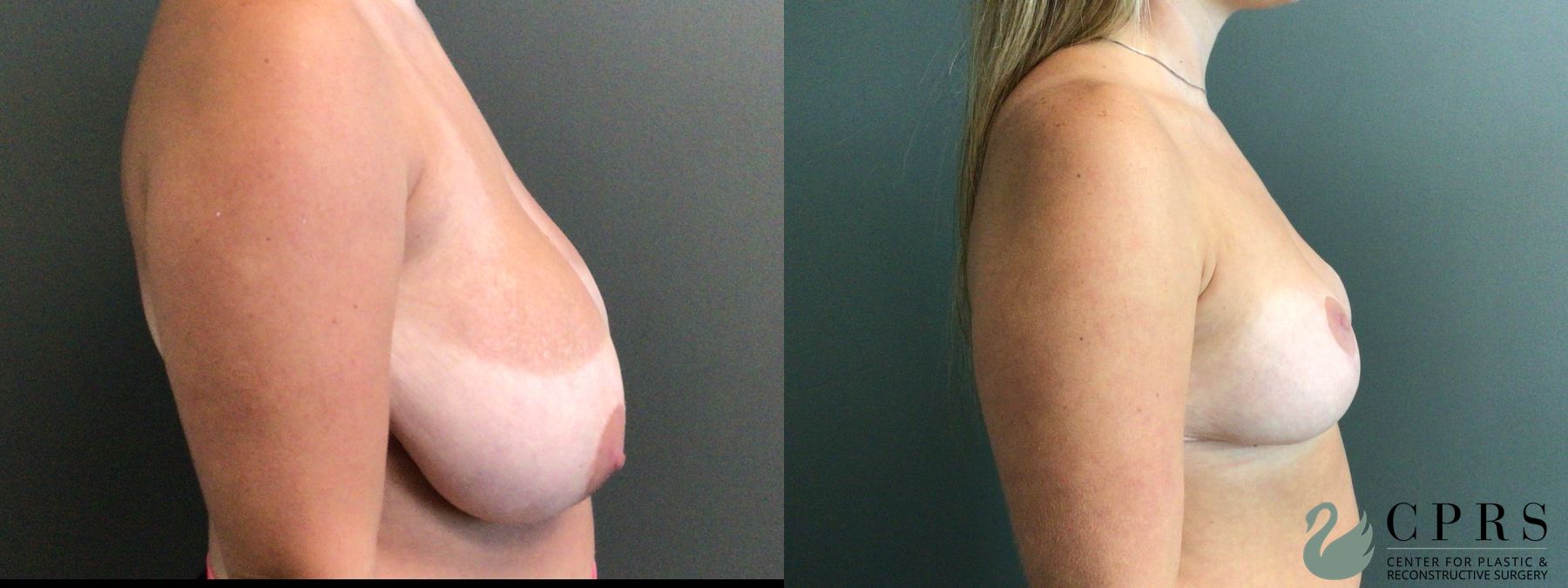 Before and after Breast Reduction case 46139 - Angle 2