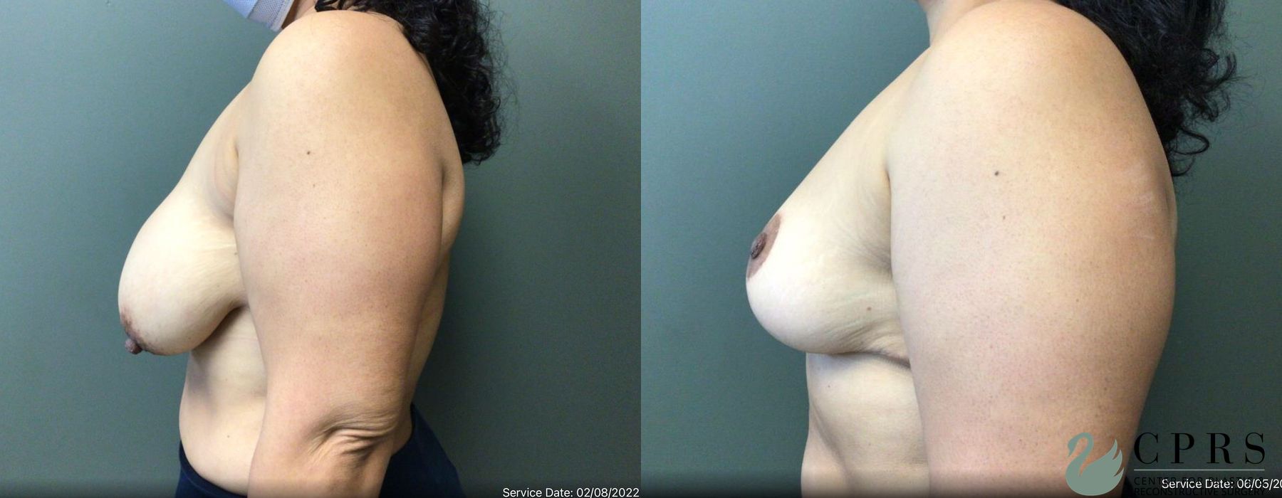 Before and after Breast Reduction case 19140 - Angle 3