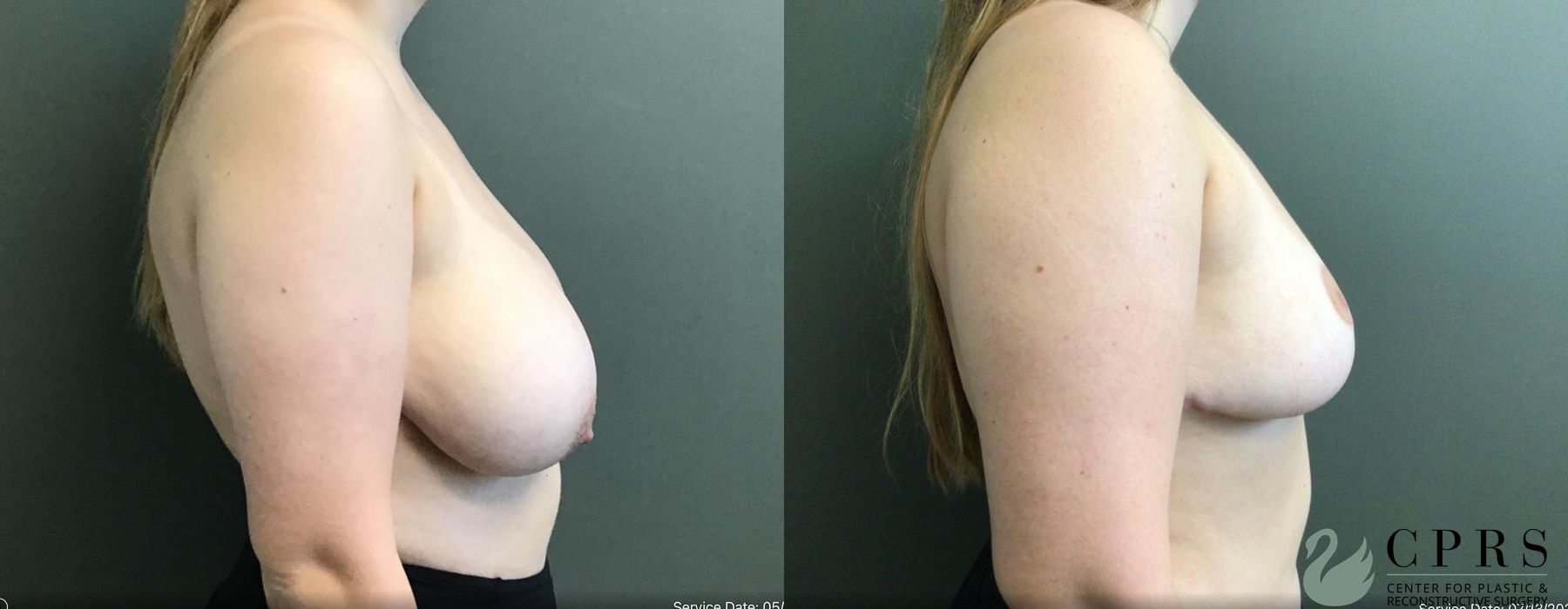 Before and after Breast Reduction case 19129 - Angle 3