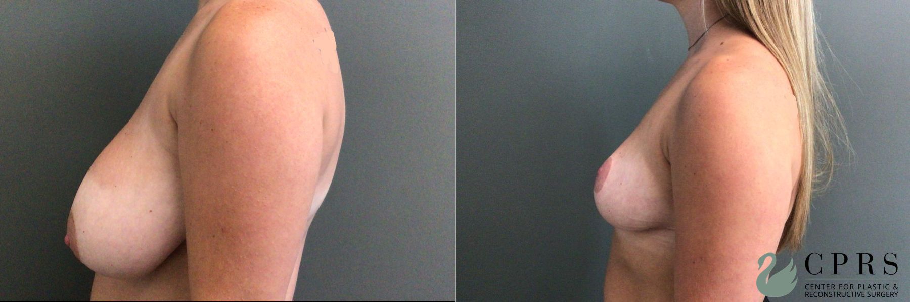 Before and after Breast Reduction case 46139 - Angle 3