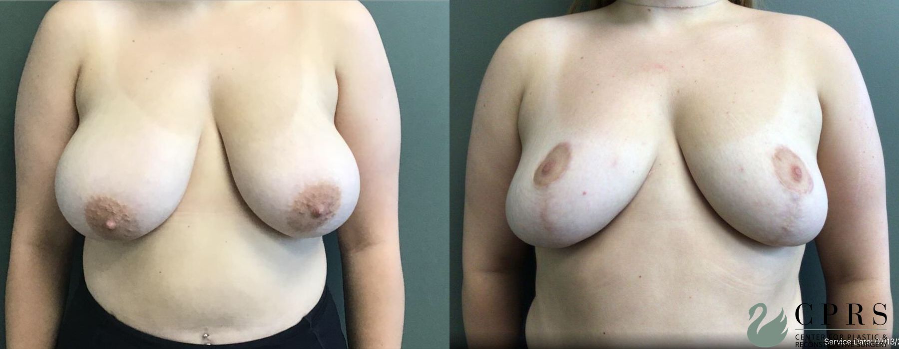 Before and after Breast Reduction case 19129