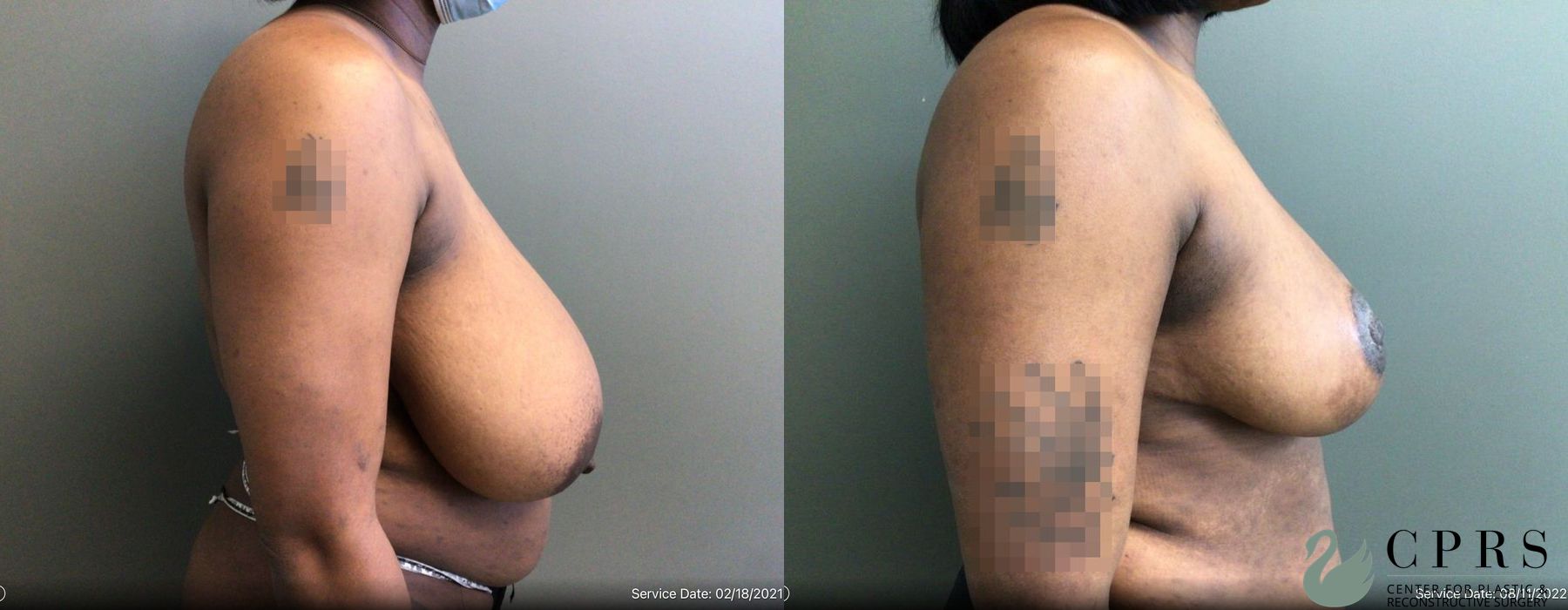 Before and after Breast Reduction case 19121 - Angle 3
