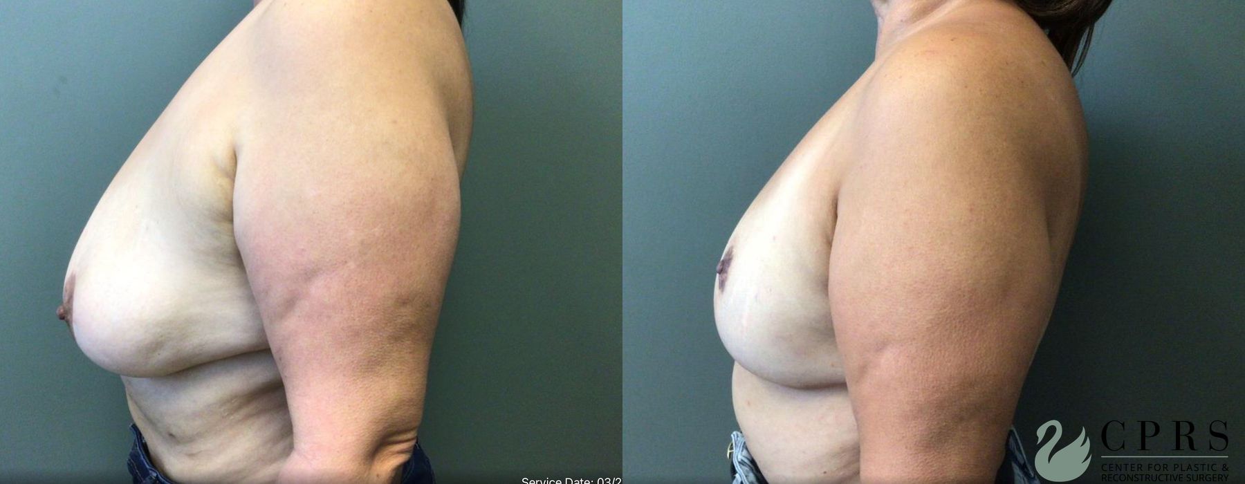 Before and after Breast Reduction case 19022 - Angle 2