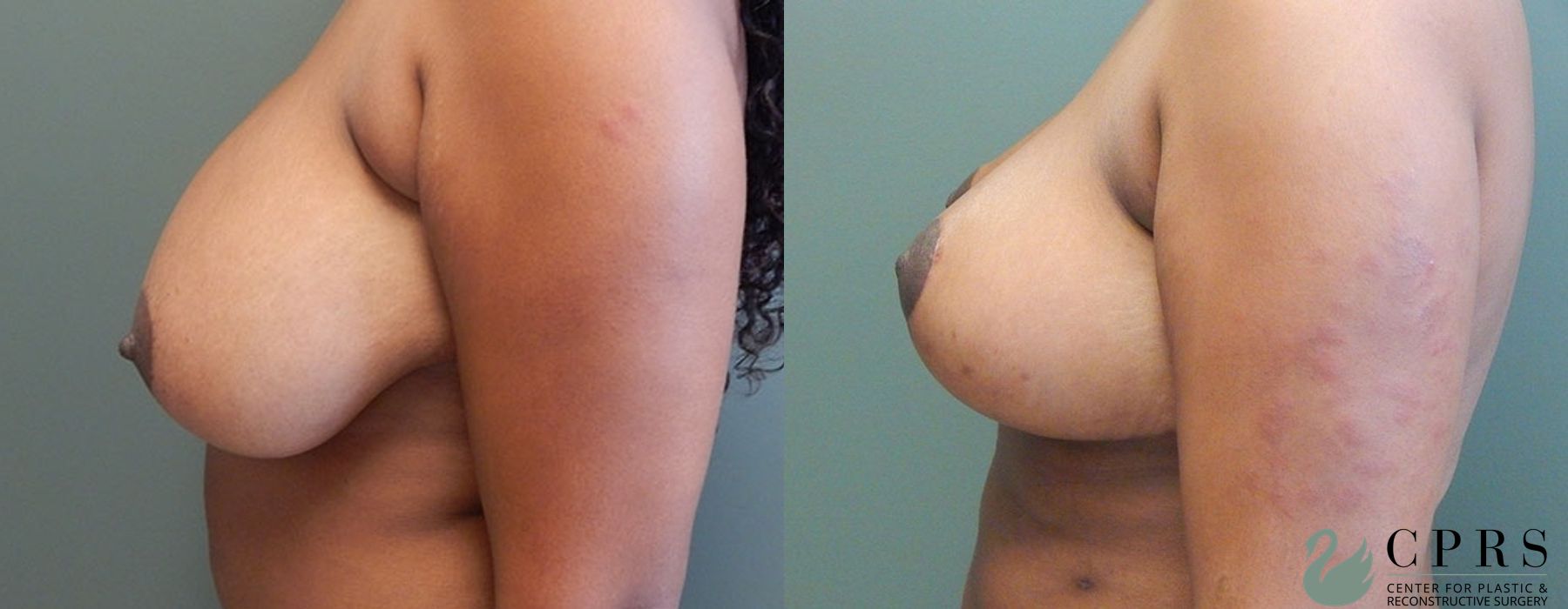 Before and after Breast Reduction case 18982 - Angle 2