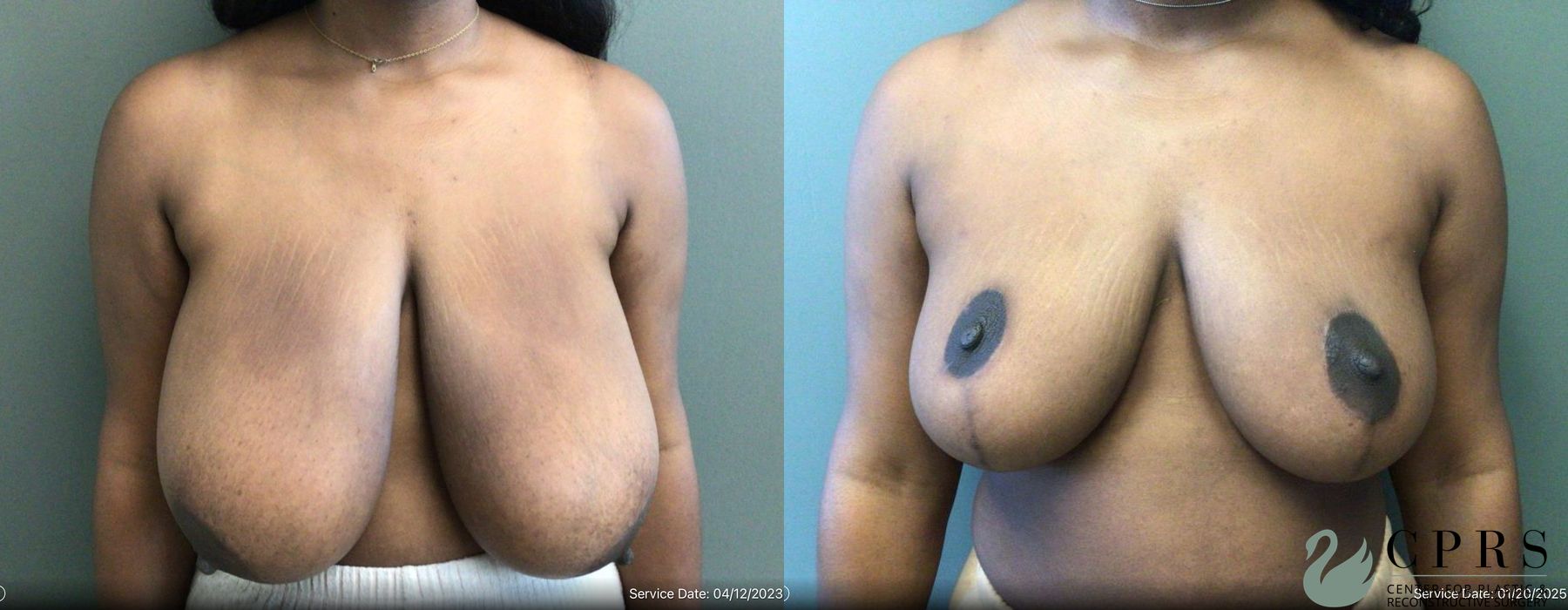 Before and after Breast Reduction case 19021
